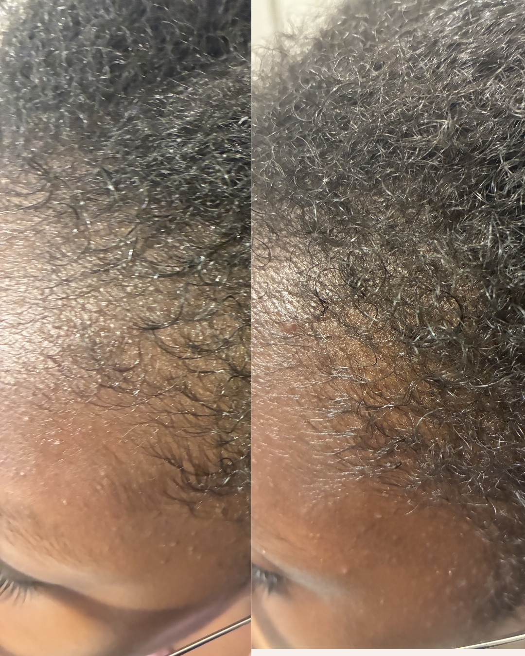 The Resilience Comb™ – Scalp stimulating