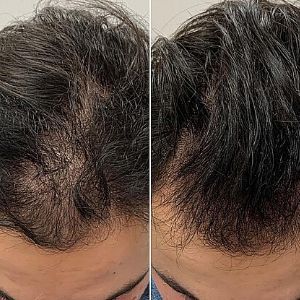 Botany & Co Hair Growth Serum – Reduce Hair Loss & Boost Regrowth